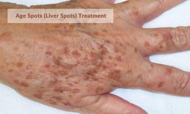 Age Spots (Liver Spots) Treatment Beverly Hills